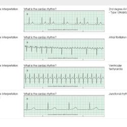 Relias dysrhythmia basic a answers