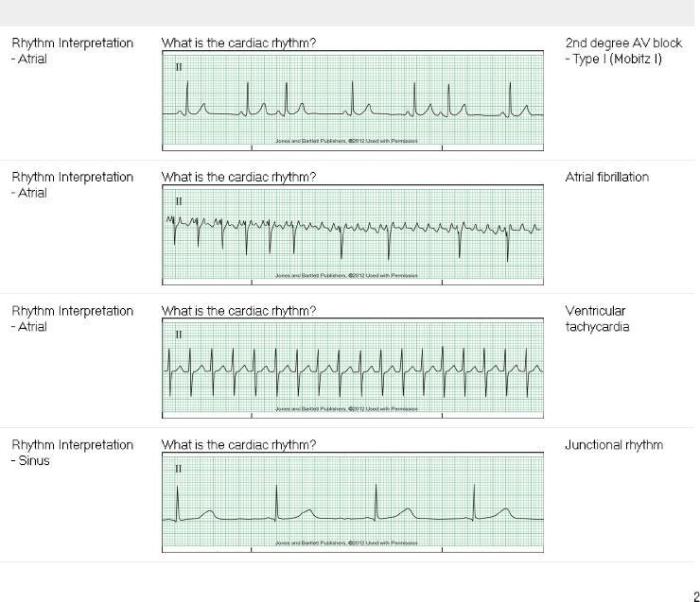 Relias dysrhythmia basic a answers